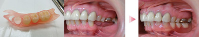 フレキサイト義歯
